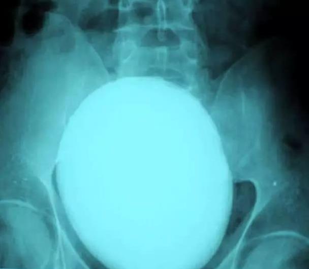 肺癌|盘点30张奇奇怪怪的X光片，看完整个人都不好了！