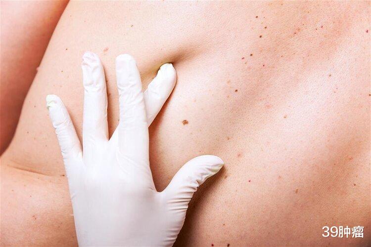 黑色素瘤|手臂上的痣超过11颗,患癌几率越大?4种方法教你找出“坏痣”