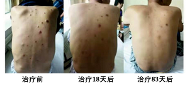 car-t|一针卖290万？国产抗癌“神药”在日本获批上市，能治愈癌症吗