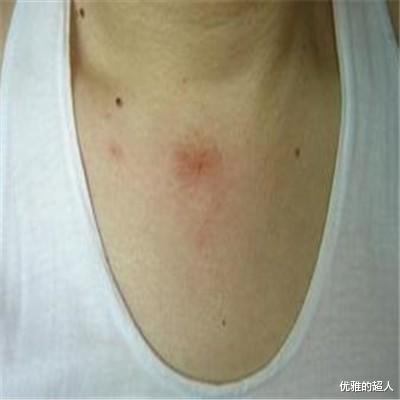 腰椎间盘突出|皮肤出现这8种变化，可能是癌症发出的信号！