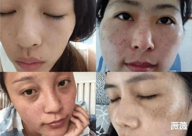 防晒喷雾 娱记曝关晓彤定期去打美白针，因身体受到影响，露面都靠全身擦粉