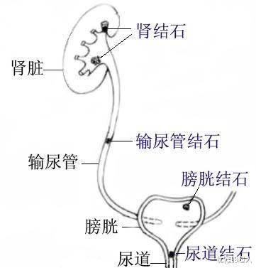肾结石|你真的了解肾结石么？该如何防治？