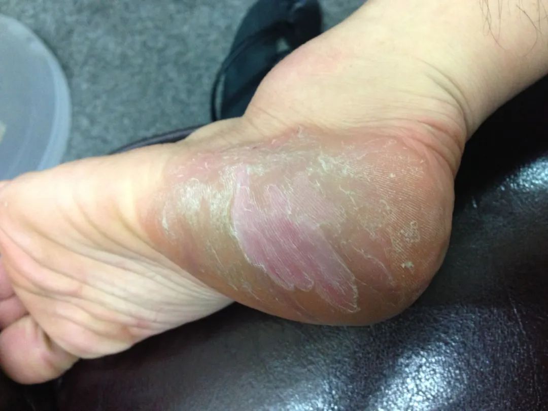 土家族|脚臭的朋友注意,养成这4个生活习惯,或能远离脚臭的困扰