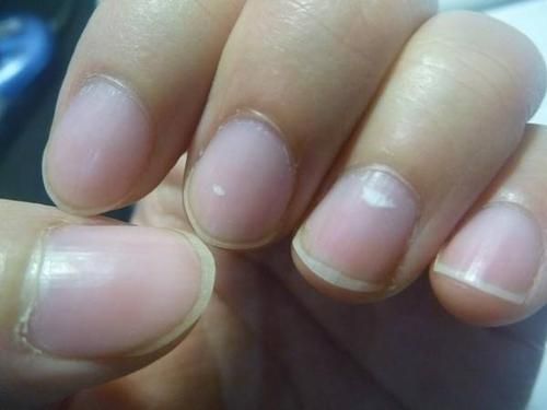 肝脏|肝是否健康?“竖起中指”看看,若无这6种表现,说明刚脏还不错