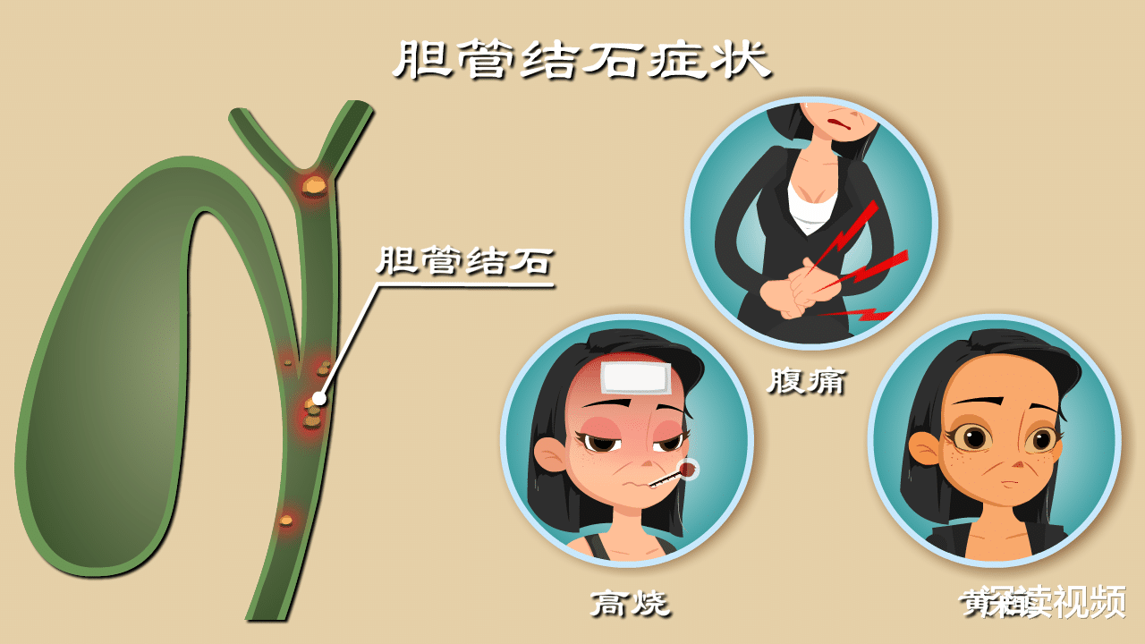 乳腺结节|六旬大爷多发胆管结石不自知，切肝保命！教你3招辨别胆管结石