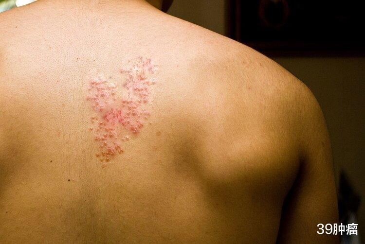 皮肤病|体内有癌,皮肤知道?查出4种“皮肤病”,警惕癌症来袭