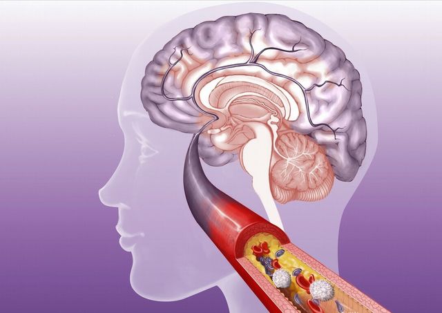 长寿|身体常有5个征兆,十有八九被“脑梗”盯上了,请不要忽视