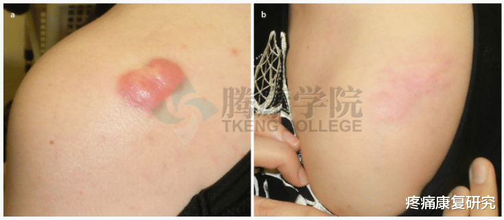 皮炎|皮质类固醇贴剂治疗瘢痕疙瘩和增生性瘢痕