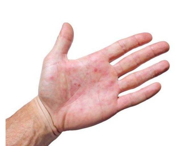 蛋白尿|肝变硬化身上有4种表现，做好这几件事，肝硬化或许不攻自破