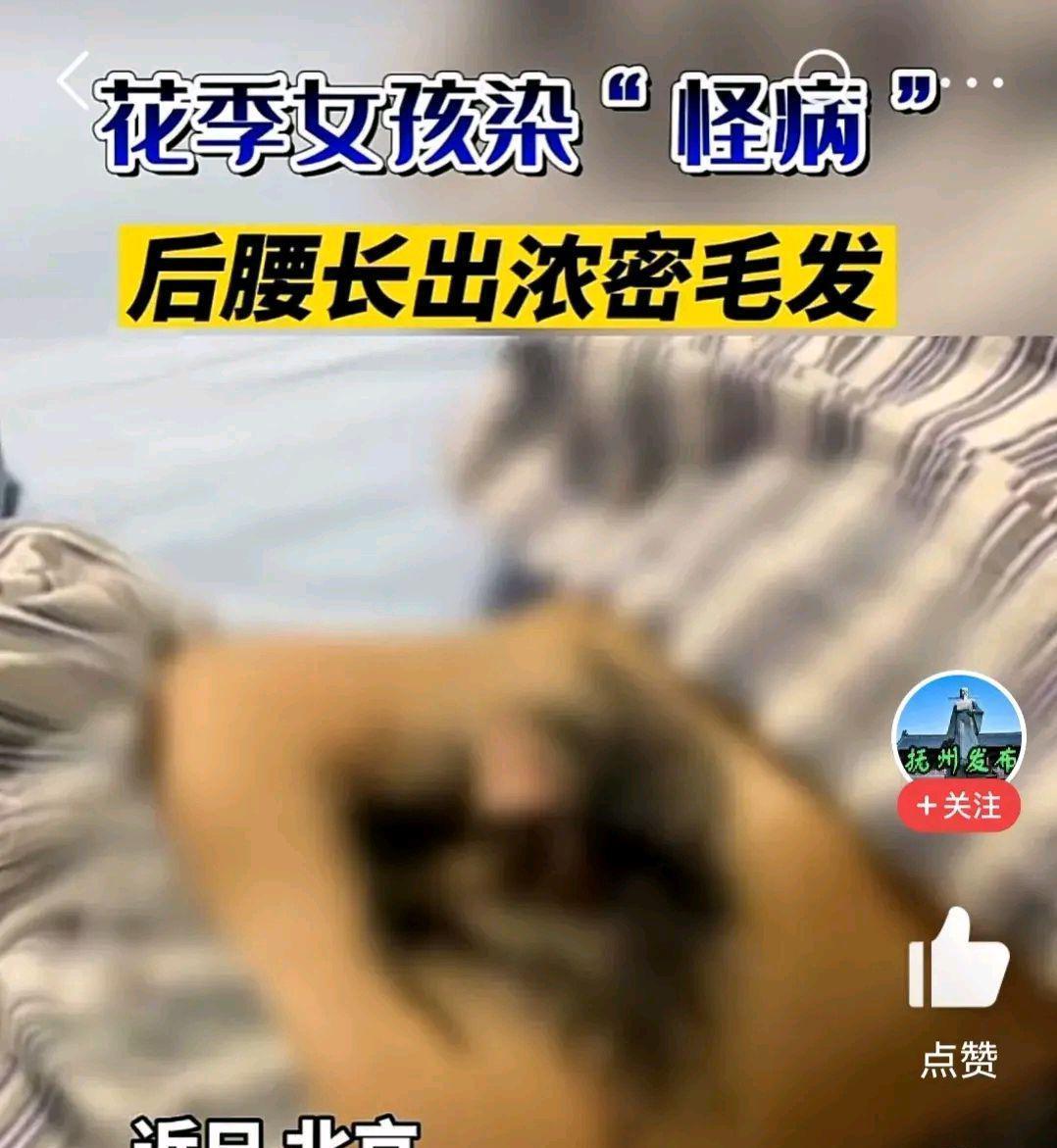 艾草|女孩染怪病后腰长出浓密毛发