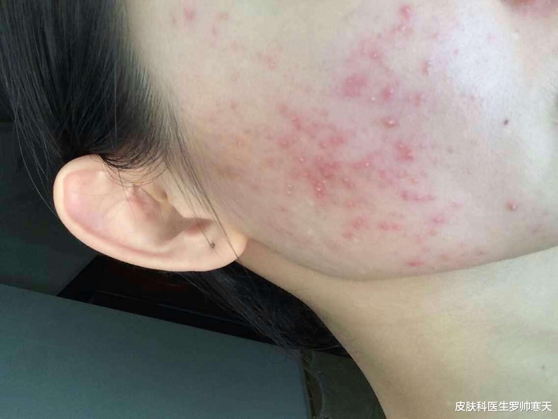 发型 皮肤科医生超全的长痘期间注意事项总结,不花钱的护肤秘籍就在这
