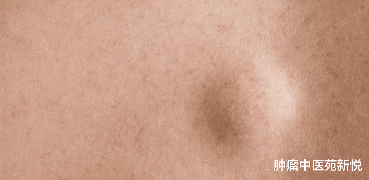 经典|一个简单的方子,淋巴结肿大月余就消散了!