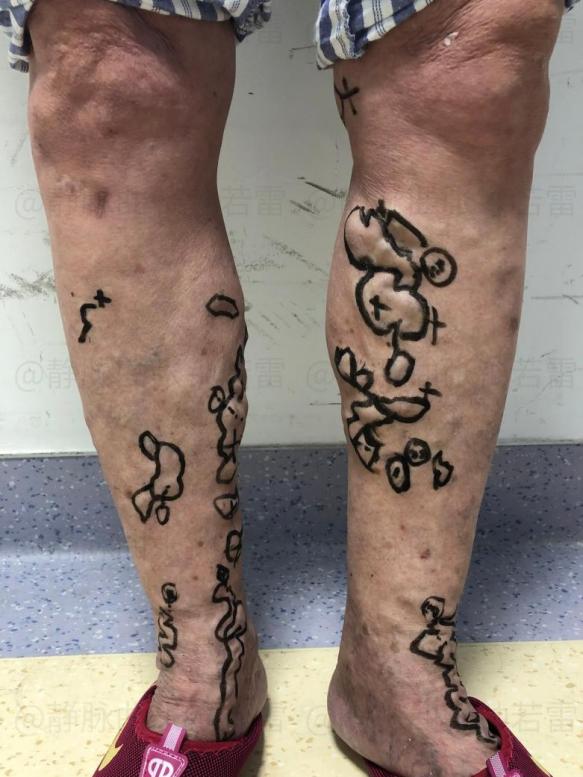 淋巴瘤|「静脉溃疡案例12」误以为老烂腿会传染,妻子被丈夫嫌弃分房十年
