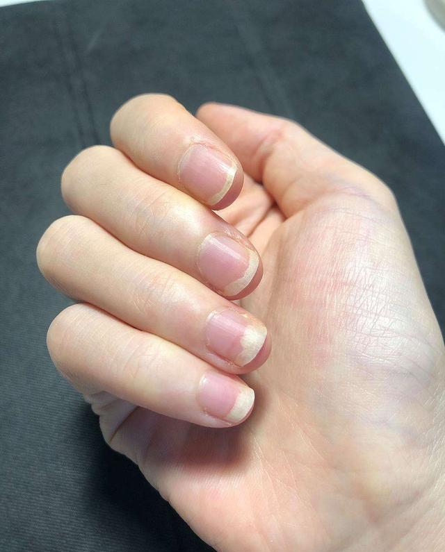 痛风|大蒜在眉毛上擦两下，能够帮助我们解决什么问题？早了解早好