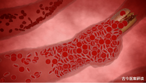 脑梗|?脑梗是吃出来的?已有人瘫痪,提醒:早餐常吃这2样,是给血管“添堵”