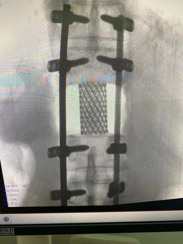 肿瘤|当心!出现这种疼痛可能导致瘫痪