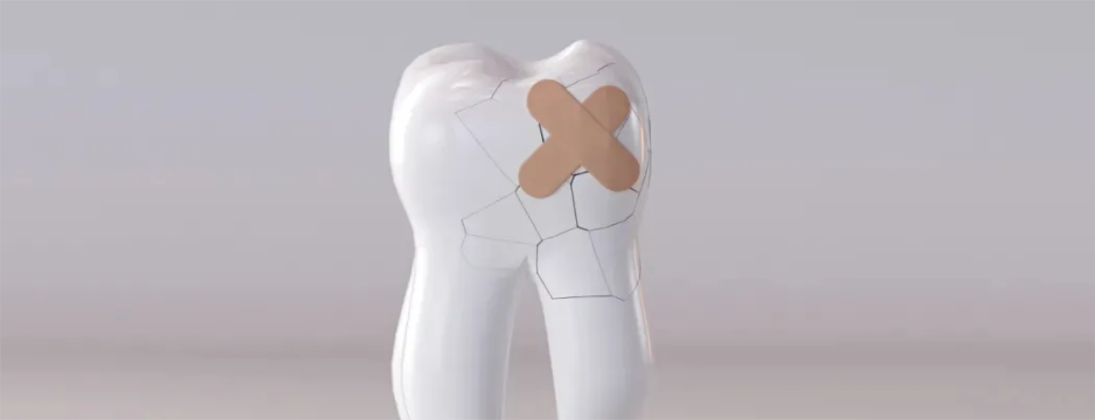 牙齿|牙齿崩掉一块怎么办?