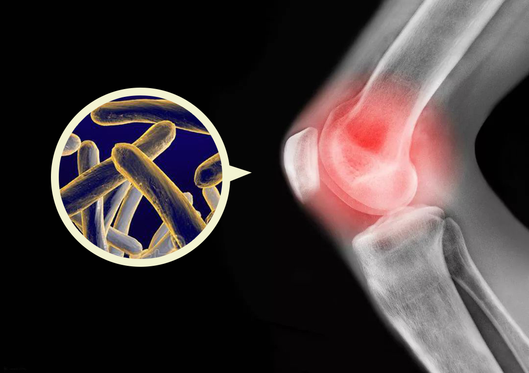 滑膜炎|得了滑膜炎应该怎么办？
