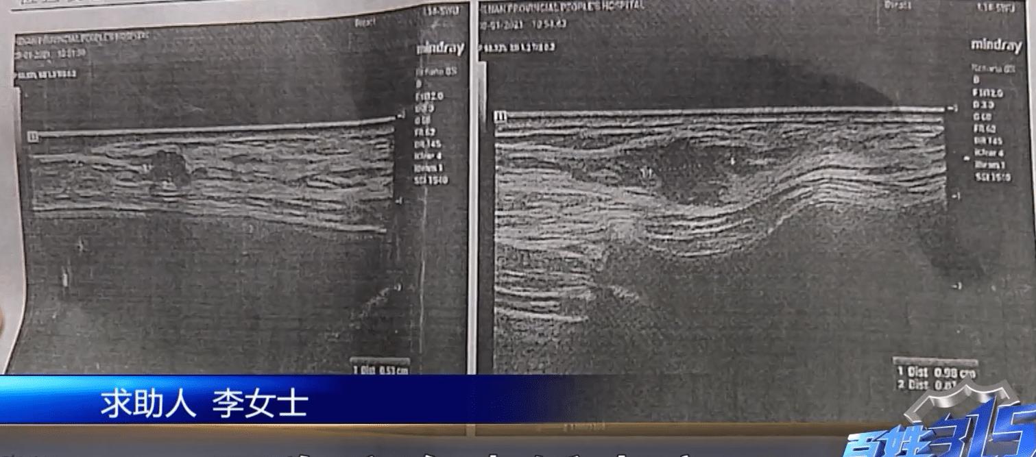 感冒|女子隆胸后怒告医院：我才20岁，和老公同房一点知觉都没有