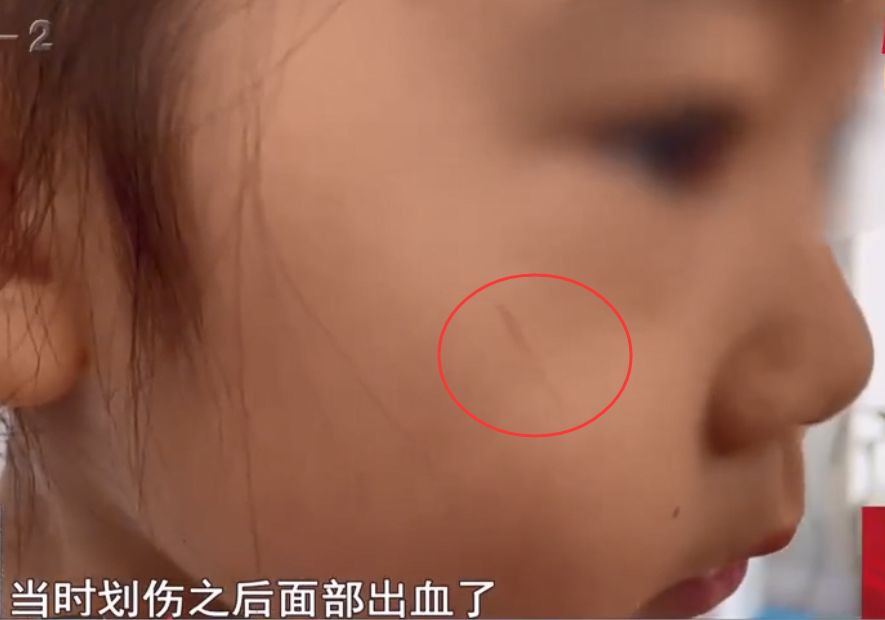 山东：女儿脸部被校长儿子划伤，父亲索要5000赔偿被拒：我给1000