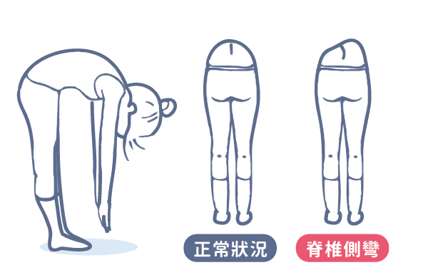 胃黏膜|脊柱侧弯在哪个年龄阶段进展较快?