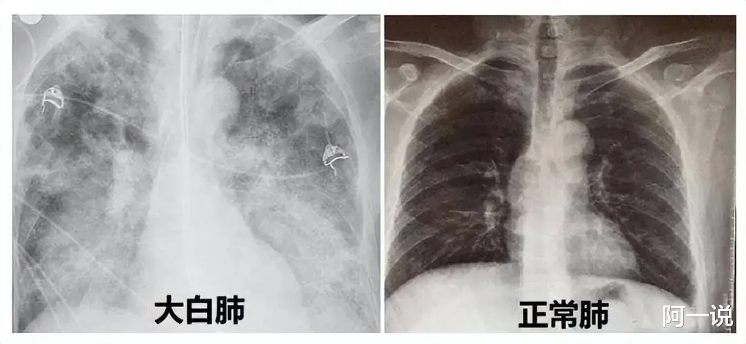 白肺|专家说白肺“欺软怕硬”,民众苦难也要娱乐化?
