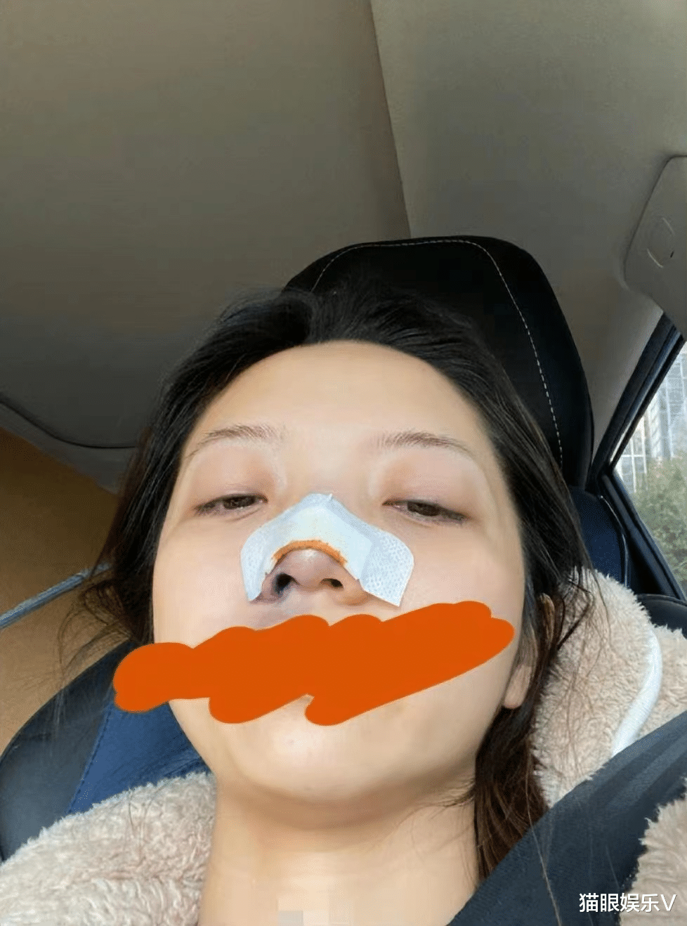 张兆艺|演员张兆艺晒受伤照片,自曝惨遭妈妈家暴,鼻子受伤裹纱眼眶含泪