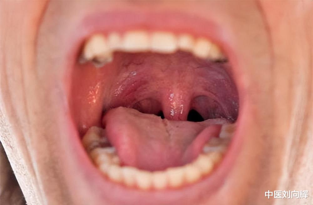 咽炎|咽干、咽痛、咽部异物感,慢性咽炎怎么治?四个小方法统统调理好