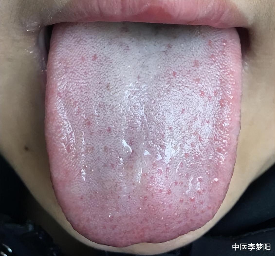 高血压|失眠、早醒、多梦怎么办?李医生教你正确精准参考中成药