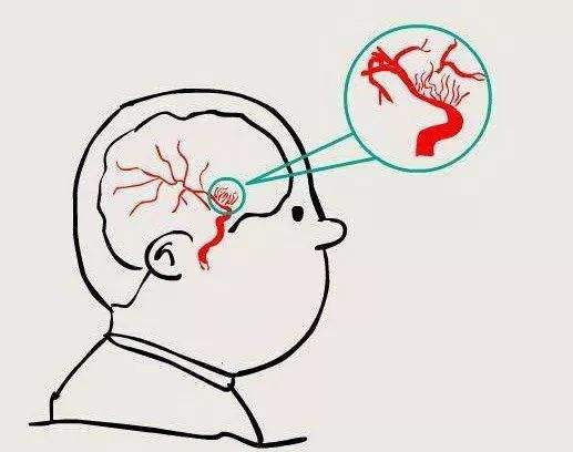 黑色素瘤|既往有脑出血还能溶栓吗?医学科普