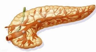 便秘|胰腺癌是否会遗传?看看专家怎么说