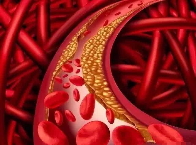 血栓|血管堵没堵，弯腰摸这里就知道！简单1个动作，帮助“畅通”血管