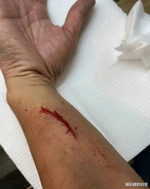 林峰|林峯拍戏意外受伤！胳膊多处伤口红肿严重，表面皮肤受损露出血肉
