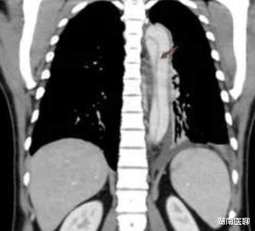 主动脉夹层|一招除“虎患”！石门县人民医院成功救治两例主动脉夹层患者