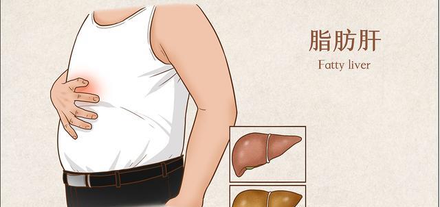 脂肪肝|滴酒未沾，怎么会得了脂肪肝呢？脂肪肝究竟和什么相关？