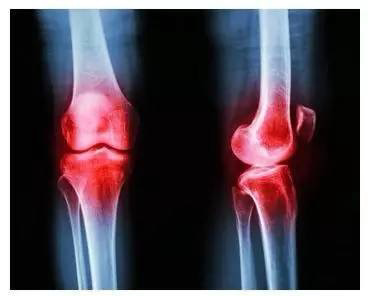 胃癌|治骨关节病,先调气血!气血与骨骼密切相关