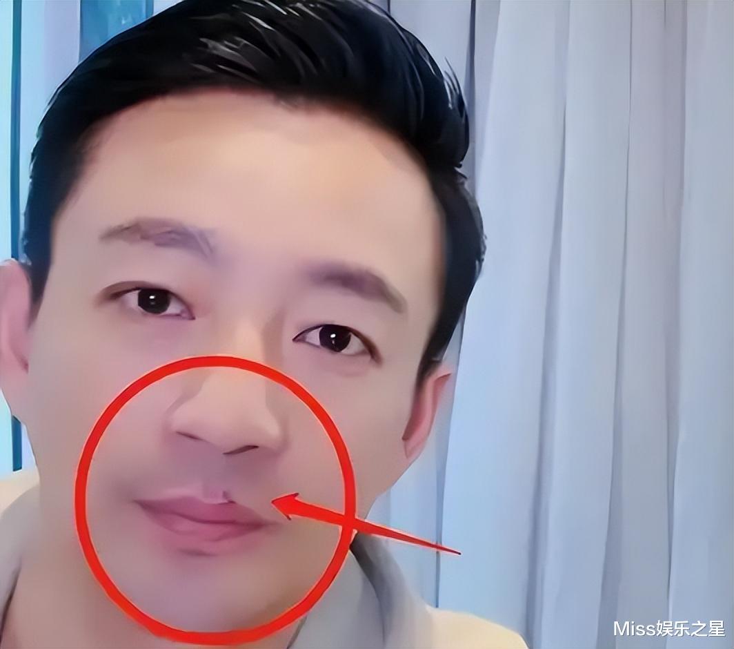 周星驰|汪小菲疑似与张颖颖复合，嘴角伤痕被指是咬伤，网友深扒两人细节