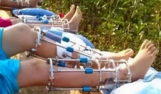 迪士尼|曾花16万断骨,只为长高7.2厘米的李亚诺,如今与后遗症为伴