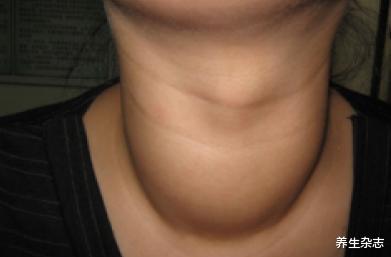 医生|34岁博士查出甲状腺结节,仅半年癌变,医生叹息:起床1习惯害了他