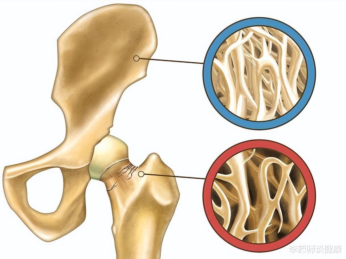 糖尿病肾病|糖尿病肾病不想发展成尿毒症,需警惕这6个症状!别不当回事