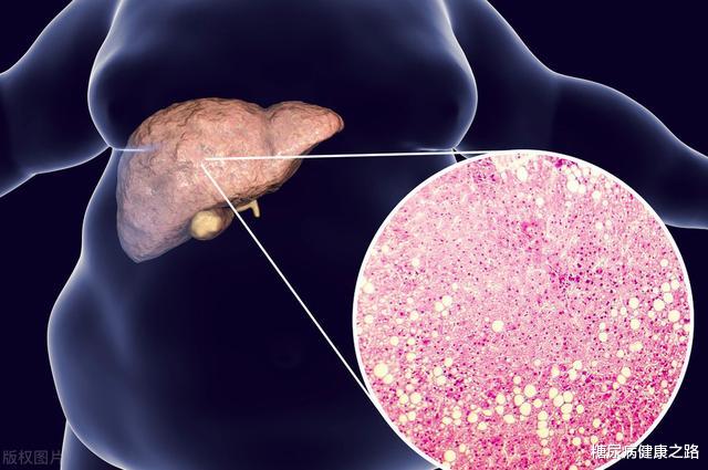 饮食|脂肪肝会引起肝硬化,研究发现可能与肠道菌群有关,7点来改善