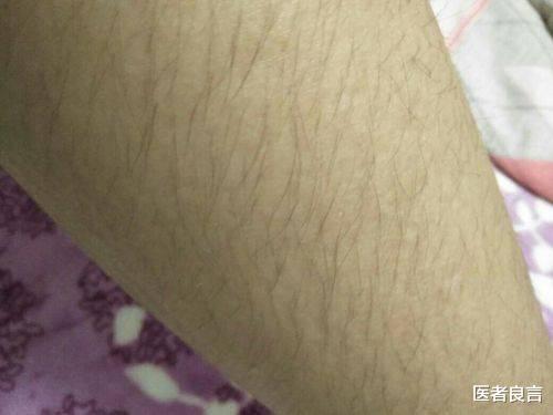 类风湿关节炎|为什么有的女性毛发旺盛,有的却很“稀疏”呢?看完涨知识了