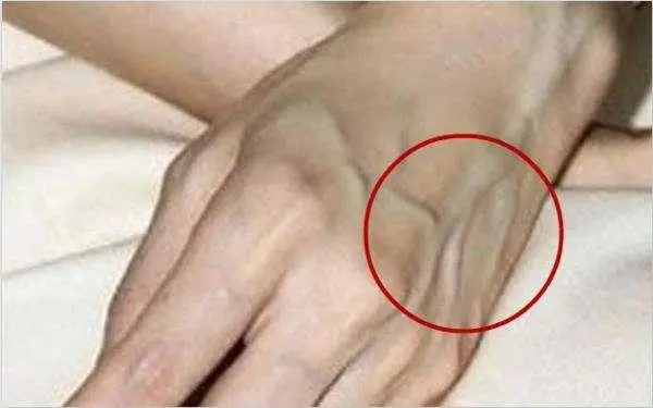 |手上“青筋暴起”到底有没有问题，听听专家是怎么说的