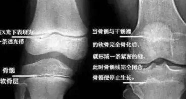 迪士尼|曾花16万断骨,只为长高7.2厘米的李亚诺,如今与后遗症为伴