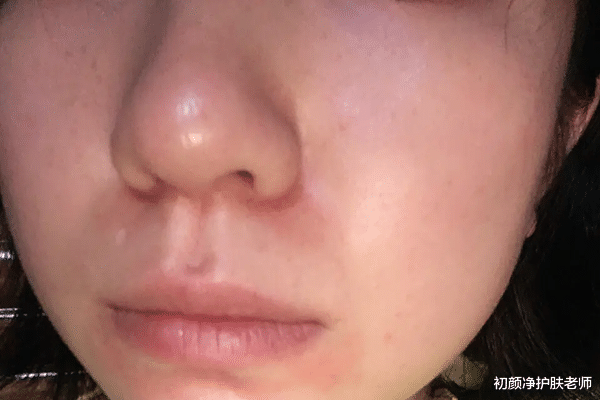 渔夫帽 皮肤屏障受损,你的保湿真的做对了吗?