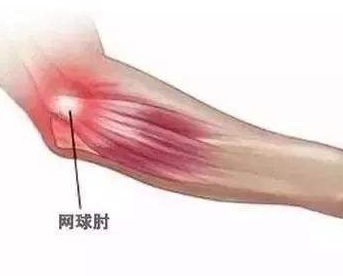 妇科|拧毛巾手臂痛是什么原因?