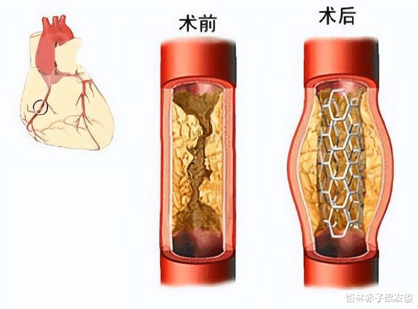 心肌梗塞|心脏支架是“救人架”还是“害人架”,装完人就废了?告诉你大实话!