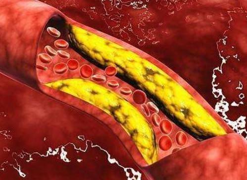 西红柿|得高血压多少年后，就可能会发生心梗、脑梗、脑出血？如何预防？