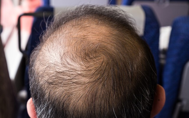 脱发|什么是“男性型脱发”？除了烟酒，还有7大原因“威胁”男性脱发