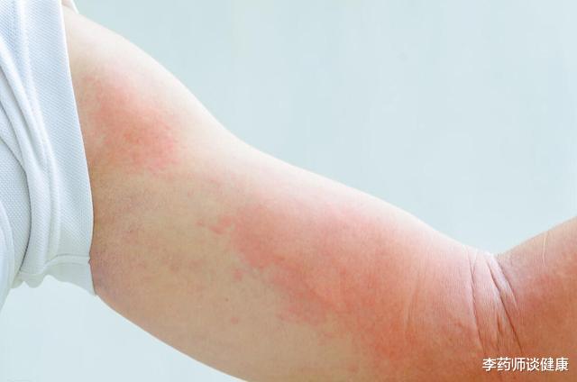 玉屏风散|一到秋天就犯鼻炎，吃玉屏风散能改善吗？本文讲出实情